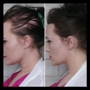 مزوتراپی مو چگونه است