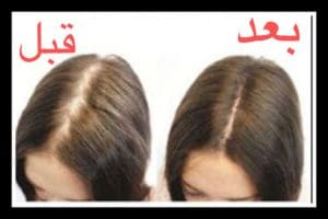 مزوتراپی مو قبل و بعد