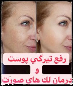 ماندگاری مزوتراپی روشن کننده