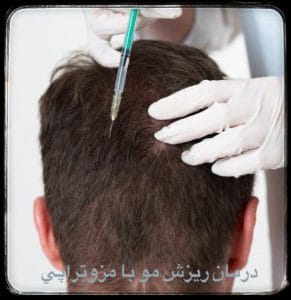 درمان ریزش مو