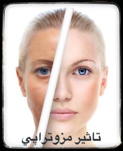 تاثیر مزوتراپی