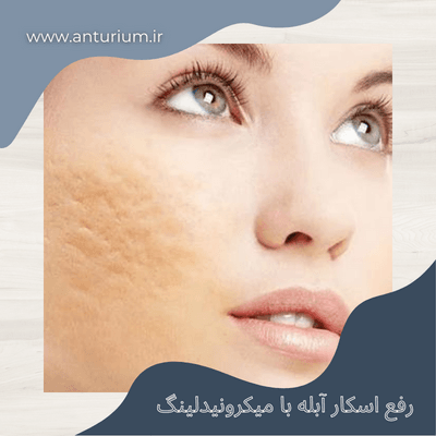 نظرات مردم در مورد مزوتراپی برای جای جوش